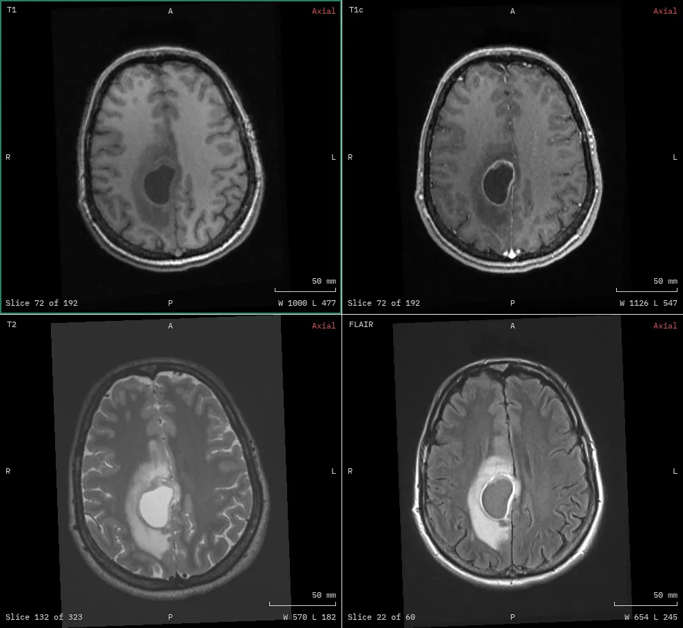 Four brain MRI sequences of a glioblastoma in a two by two grid, each showing the tumour and its oedema.