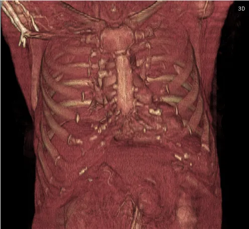 A volume rendering of the chest CT showing the spine and ribs.