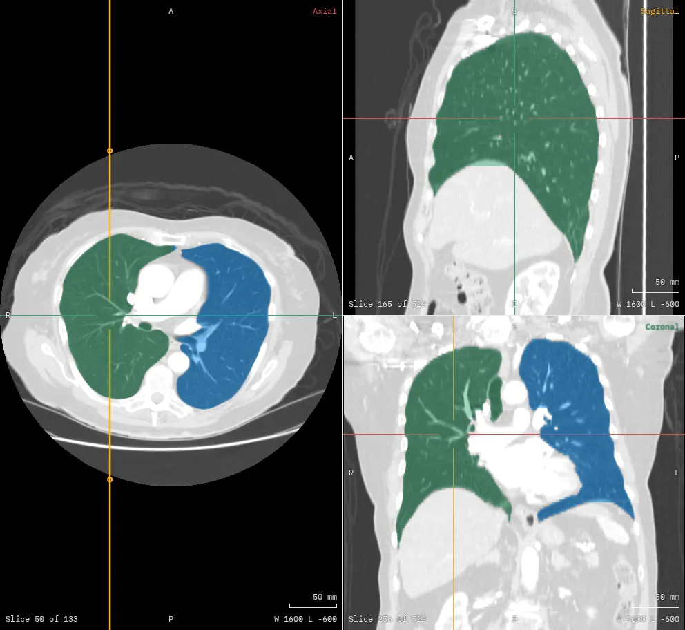 Axial, sagittal and coronal views of a chest CT, with the right lung shown in green and the left in blue.