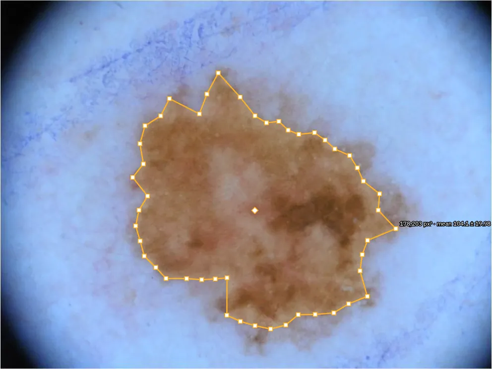 A dermoscopy image of a pigmented skin lesion with its outline.