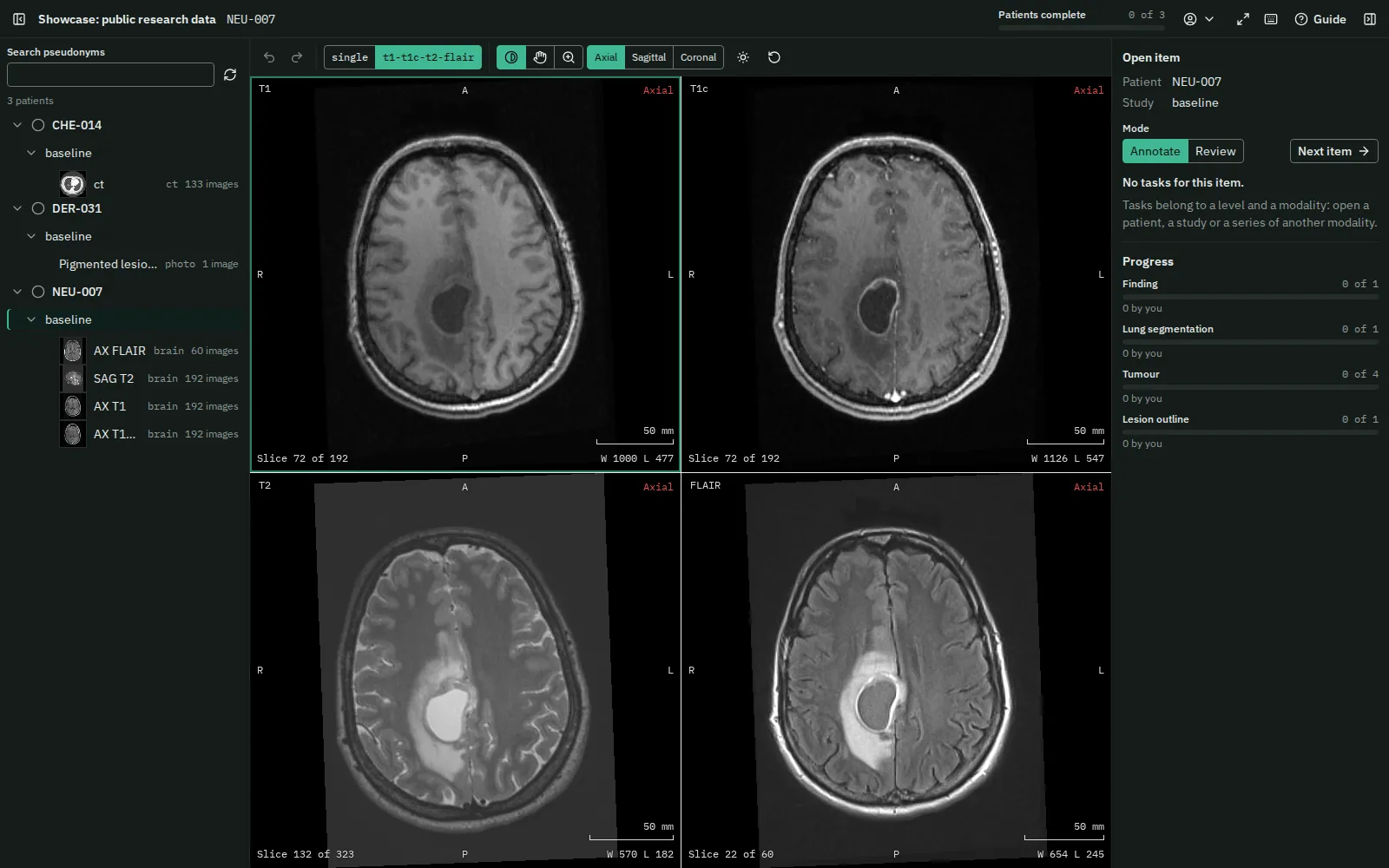 The workspace with a public brain MRI study of a glioblastoma: its four sequences, T1, T1c, T2 and FLAIR, in a two by two grid, each showing a tumour with oedema, and the tumour segmentation task.