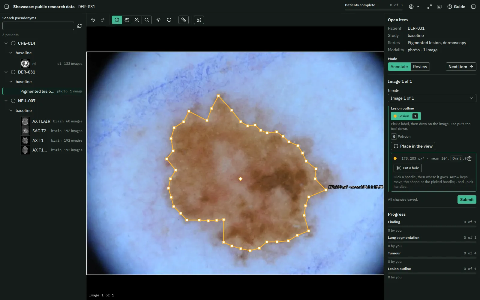 A dermoscopy image of a pigmented skin lesion with its outline drawn as a polygon, and the task panel listing the outline.